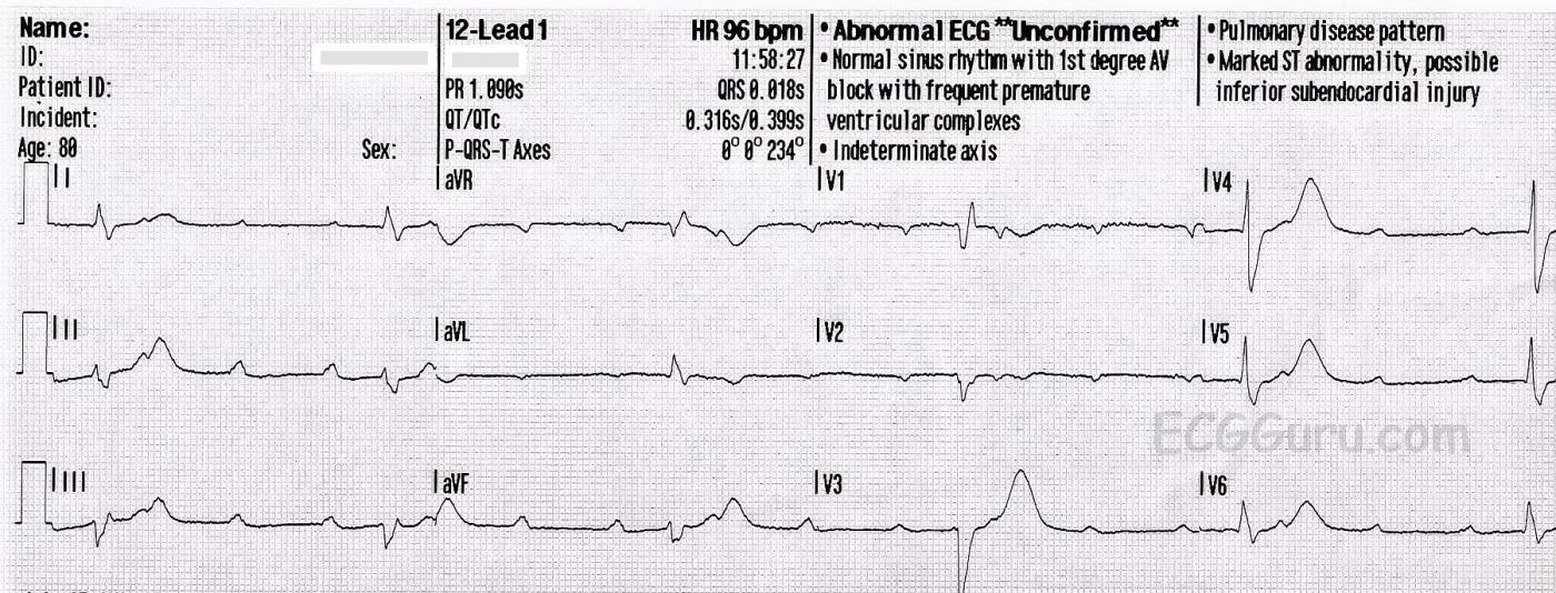 HighGrade AV Block, Seconddegree AVB Type II ECG Guru Instructor